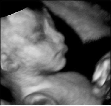 Sideview 4-D ultrasound of a fetus, zoomed in on face and chest