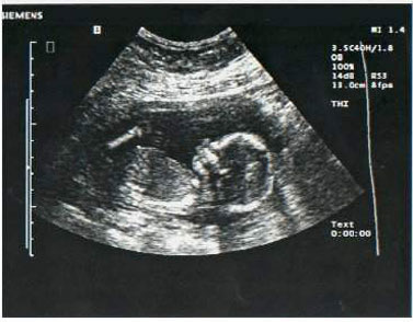 Sideview ultrasound of a fetus, view of whole body.